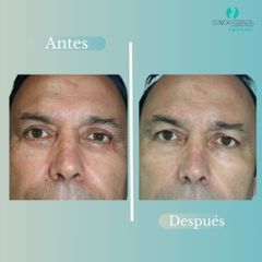 Blefaroplastia - Dr. Vicente Sanchez Liberona