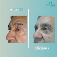 Blefaroplastia - Dr. Vicente Sanchez Liberona