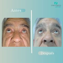 Blefaroplastia - Dr. Vicente Sanchez Liberona