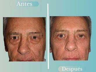 Blefaroplastía antes y después - 868815