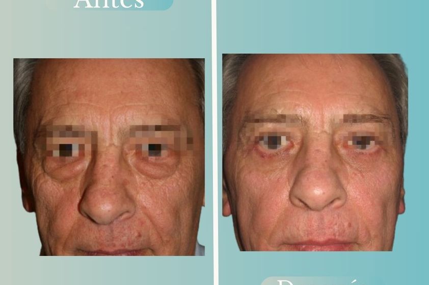 Blefaroplastía antes y después - 868815