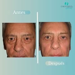 Blefaroplastia - Dr. Vicente Sanchez Liberona