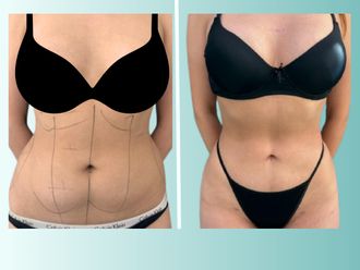 Lipoescultura antes y después - 875532