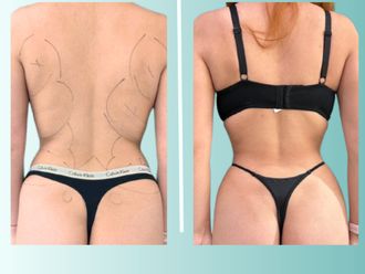 Lipoescultura antes y después - 875533