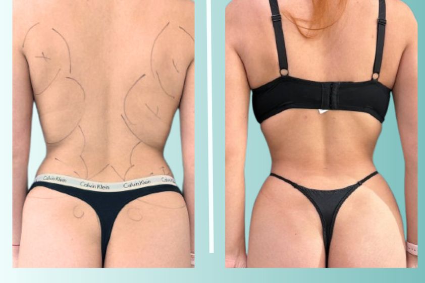 Lipoescultura antes y después - 875533