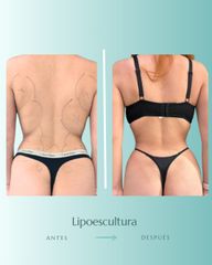 LIpoescultura - Dr. Vicente Sánchez Liberona