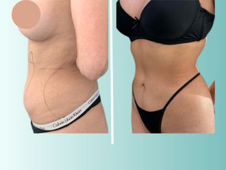 Lipoescultura antes y después - 875534