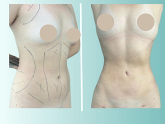 Liposucción antes y después - 875535