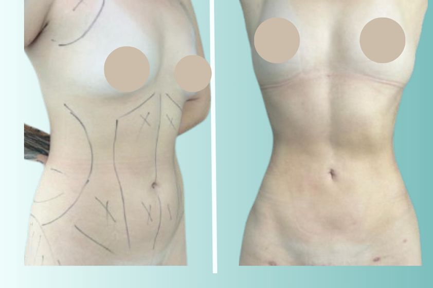 Liposucción antes y después - 875535