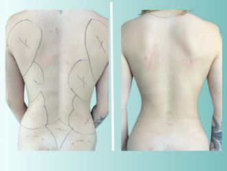 Liposucción antes y después - 875536