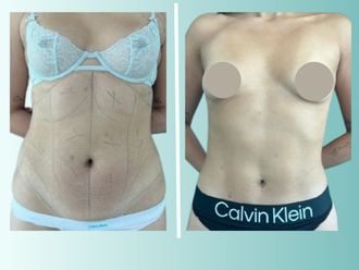 Lipoescultura antes y después - 875537