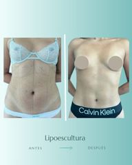 Lipoescultura - Dr. Vicente Sánchez Liberona