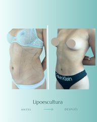Lipoescultura - Dr. Vicente Sánchez Liberona