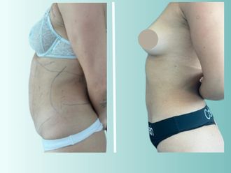 Lipoescultura antes y después - 875539