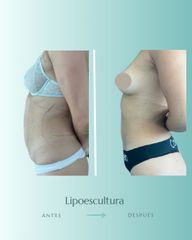 Lipoescultura - Dr. Vicente Sánchez Liberona