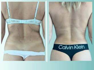 Lipoescultura antes y después - 875540