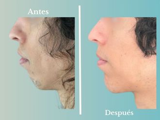 Mentoplastia antes y después - 876635