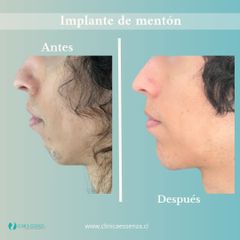 Implante de Mentón - Dr. Vicente Sánchez Liberona
