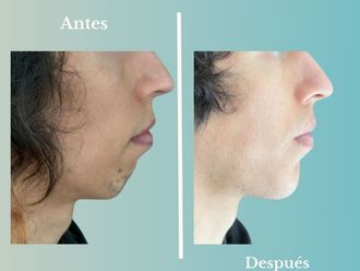 Mentoplastia antes y después - 876636