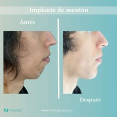 Implante de Mentón - Dr. Vicente Sánchez Liberona