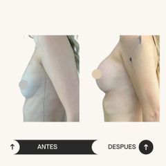 Aumento Mamario - Dr. Vicente Sánchez Liberona