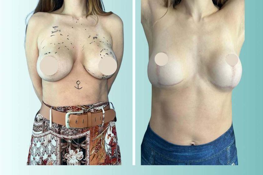 Mastopexia antes y después - 877746