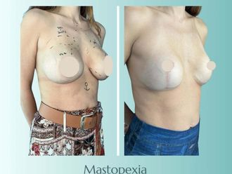 Mastopexia antes y después - 877747