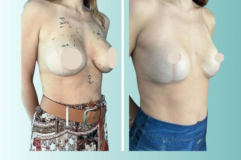 Mastopexia antes y después - 877747