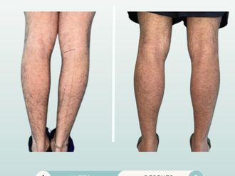 Aumento de pantorrilla antes y después - 877765