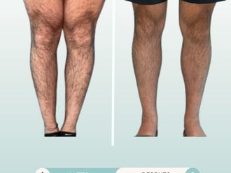 Aumento de pantorrilla antes y después - 877766