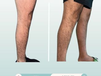 Aumento de pantorrilla antes y después - 877767