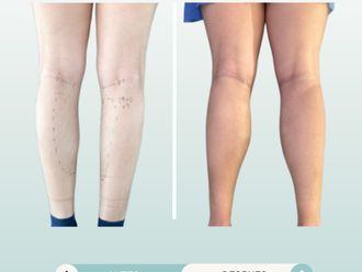 Aumento de pantorrilla antes y después - 877768