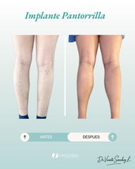 Implante de Pantorrilla - Dr. Vicente Sánchez Liberona