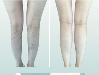 Aumento de pantorrilla antes y después - 877769