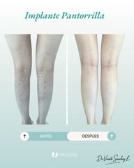 Implante de Pantorrilla - Dr. Vicente Sánchez Liberona
