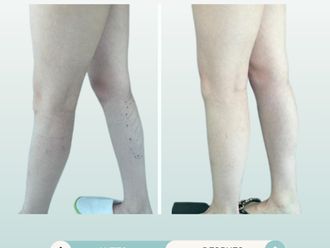 Aumento de pantorrilla antes y después - 877770