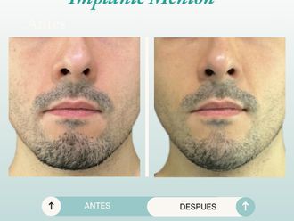 Mentoplastia antes y después - 877771
