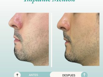 Mentoplastia antes y después - 877772