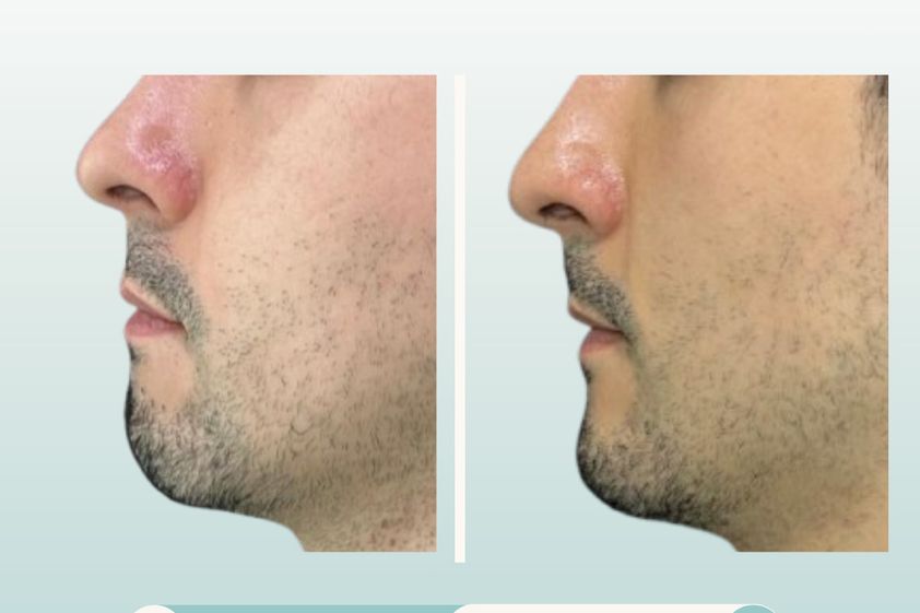 Mentoplastia antes y después - 877772