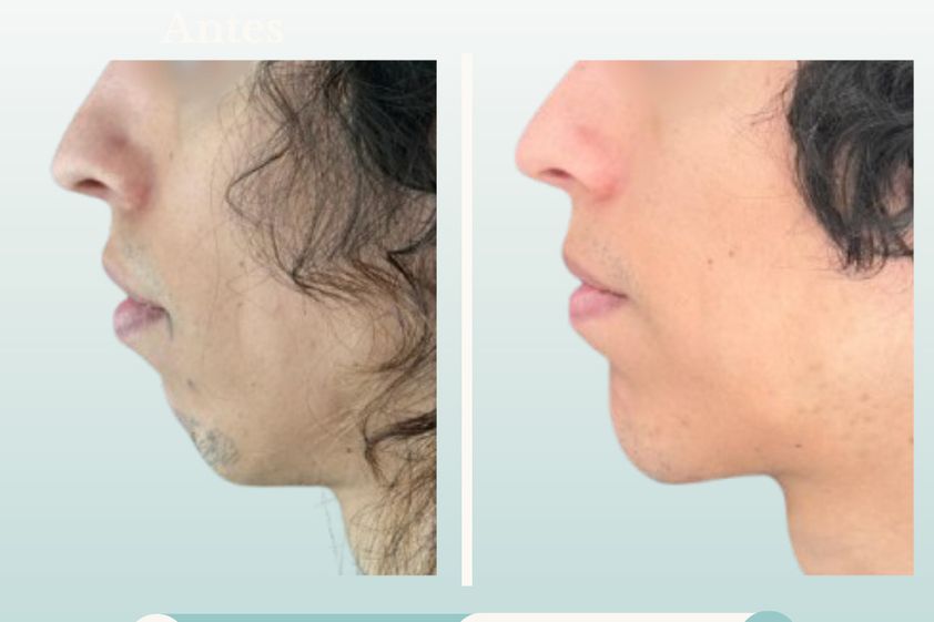 Mentoplastia antes y después - 877774