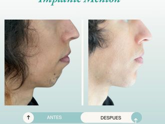 Mentoplastia antes y después - 877775