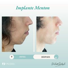 IMPLANTE DE MENTON - Dr. Vicente Sánchez Liberona