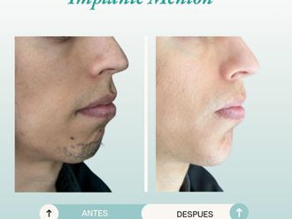 Mentoplastia antes y después - 877776