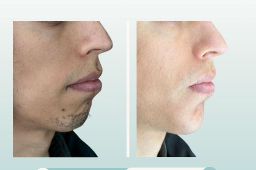 Mentoplastia antes y después - 877776