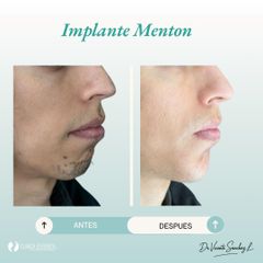 IMPLANTE DE MENTON - Dr. Vicente Sánchez Liberona