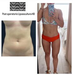 Lipoescultura HD - Clínica Copacabana