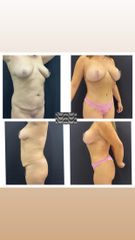 Lipoescultura/abdominoplastia/Mastopexia - Clínica Copacabana
