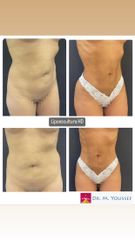 Lipoescultura HD - Clínica Copacabana
