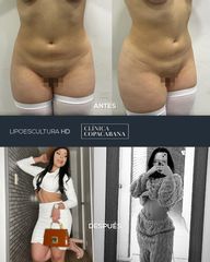 Lipoescultura - Clínica Copacabana