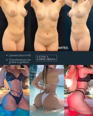 Lipoescultura - Clínica Copacabana